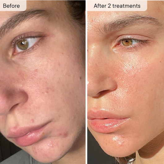 Micro-Infusion PDRN System