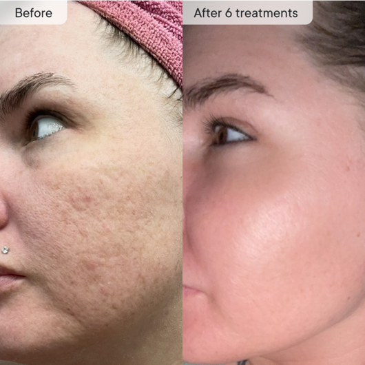 Micro-Infusion PDRN System