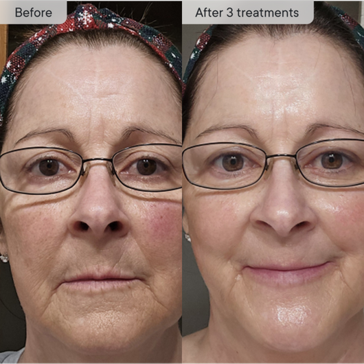 Micro-Infusion PDRN System